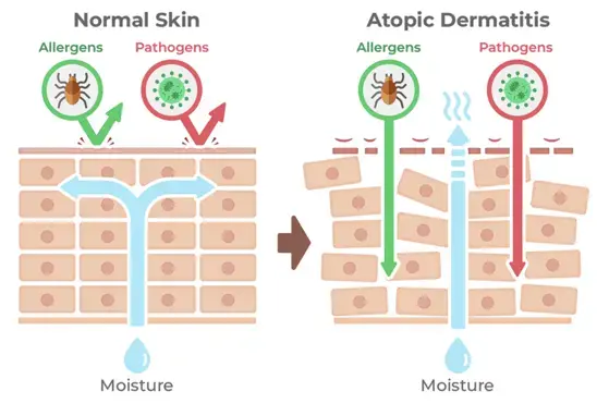 Epidermal barrier function disturbance in AD