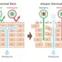 Epidermal barrier function disturbance in AD